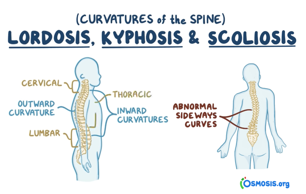 Do You Have a Curved Spine? The Three Most Common Spine Conditions