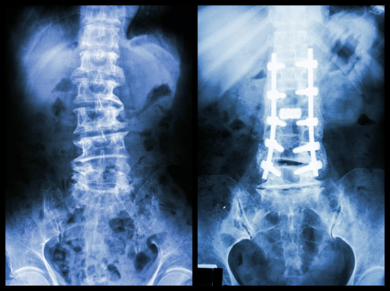 What Causes Scoliosis of The Spine? Scoliosis Therapy Centers